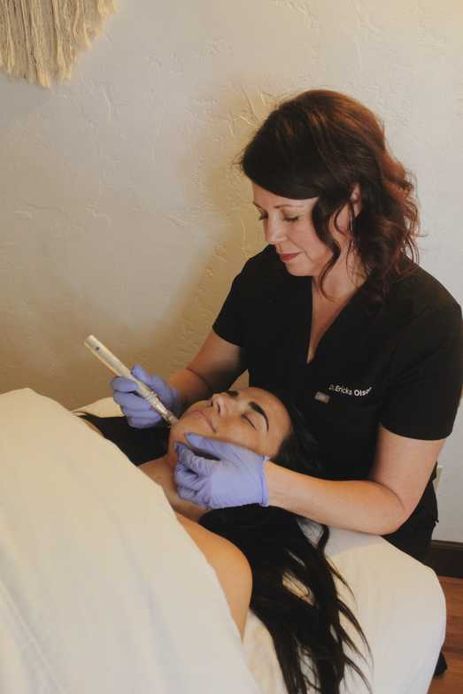 Microneedling anti aging acne fine lines Ocean Beach San Diego