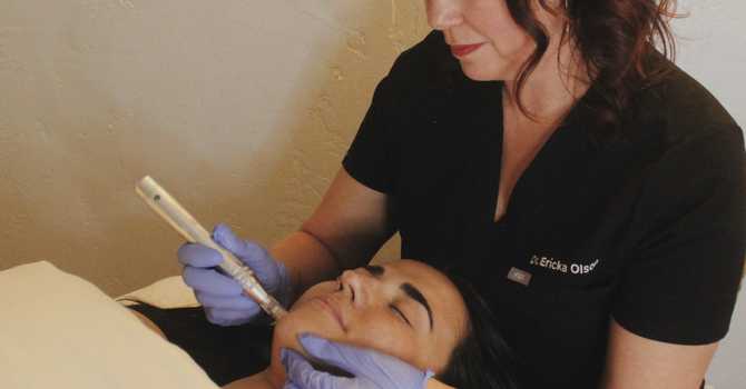 The Benefits of Microneedling: Enhancing Skin Health and Appearance image