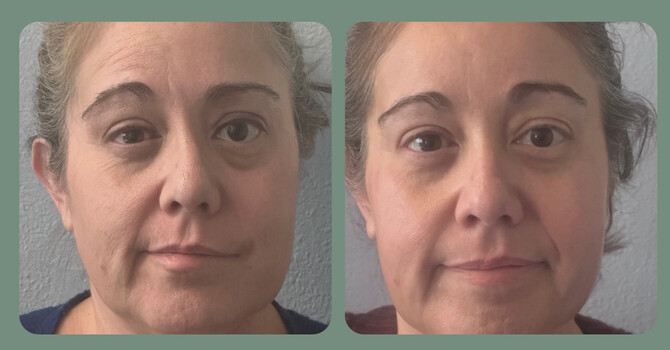 Restoring Confidence and Function: How Cosmetic Acupuncture Supports Facial Paralysis RecoveryAt  image